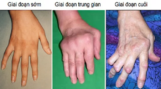Tổn thương khớp bàn tay trong viêm khớp dạng thấp