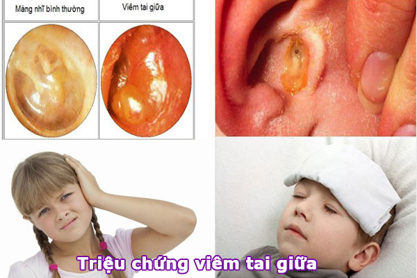 Triệu chứng thường gặp ở trẻ viêm tai giữa