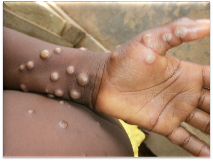 Bệnh đậu mùa khỉ gây tổn thương da